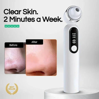 Lumii™- Blackhead Remover