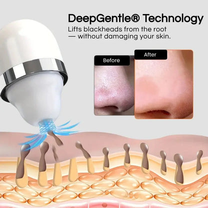 Lumii™- Blackhead Remover