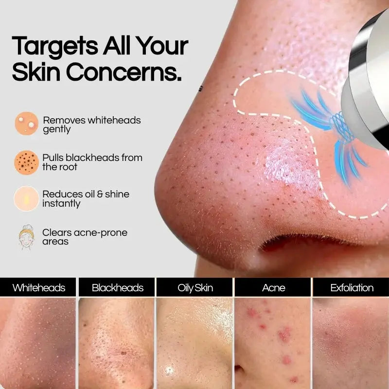 Lumii™- Blackhead Remover