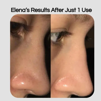 Lumii™- Blackhead Remover